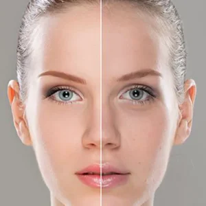 Dull Skin Treatment