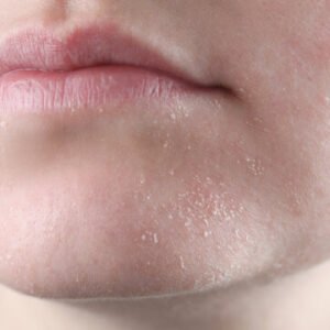 Dry skin